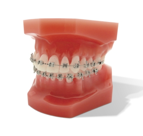 Bracket metalic miniPrevail Roth .022 Refill