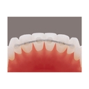 Retainer lingual Retainium TMA